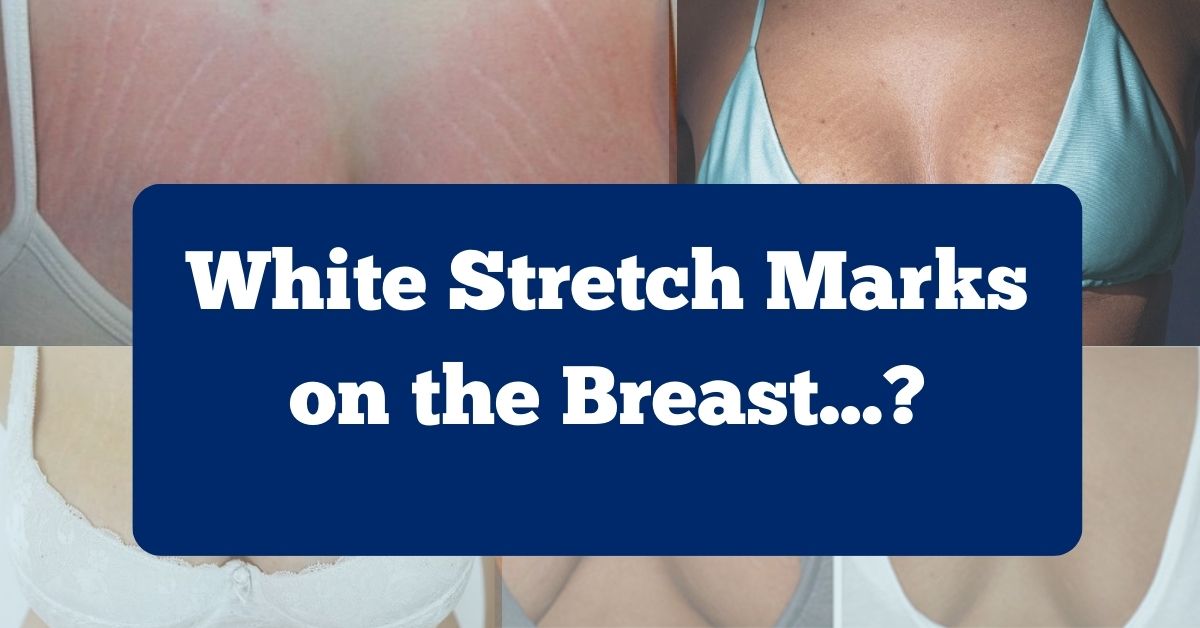 White Stretch Marks on Breast